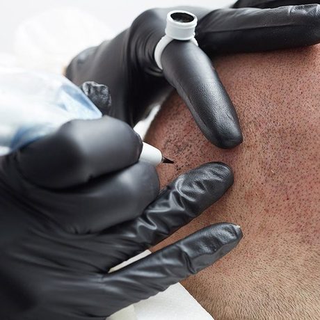 Micro-pigmentation du cuir chevelu en cours de séance