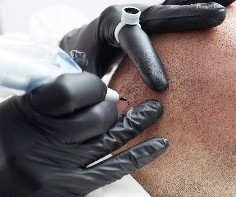 Scalp micropigmentation