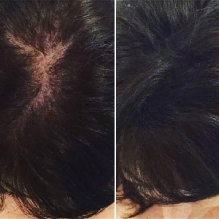 Added scalp density through micropigmentation — before and after