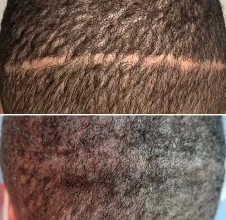 Donor scar after a hair transplant, camouflaged by micropigmentation — before and after