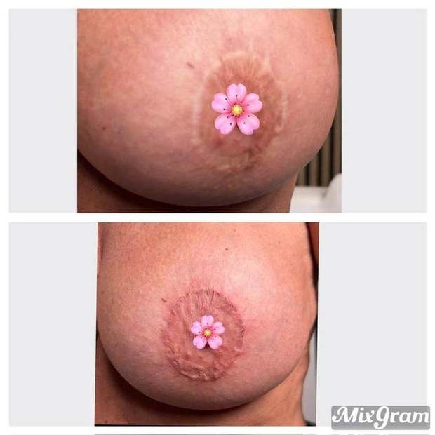 Scar camouflage after breast implants — before and after