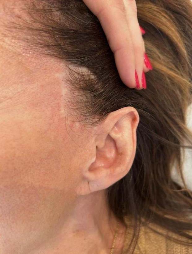 Facelift scar in front of the ear, depigmented — before camouflage