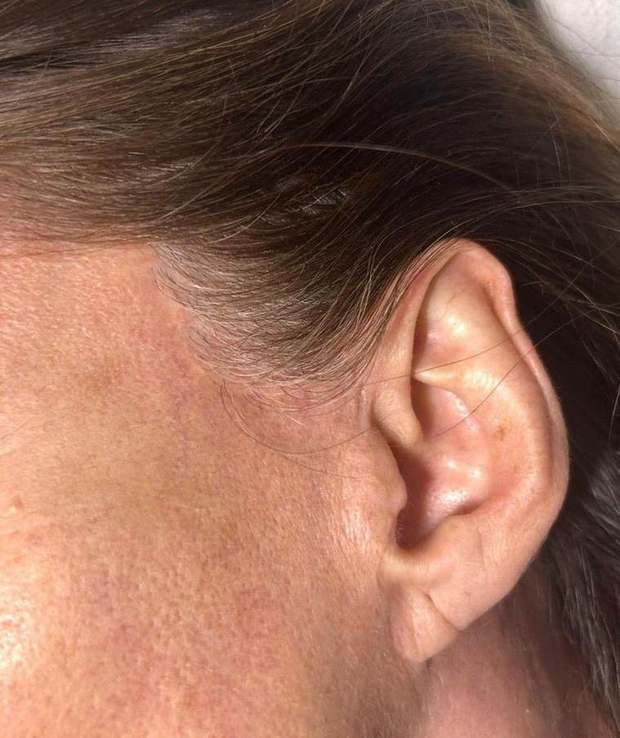 Facelift scar in front of the ear, repigmented — after camouflage