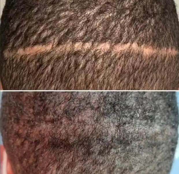 Scalp scar camouflaged with micro-dots of pigment — before and after